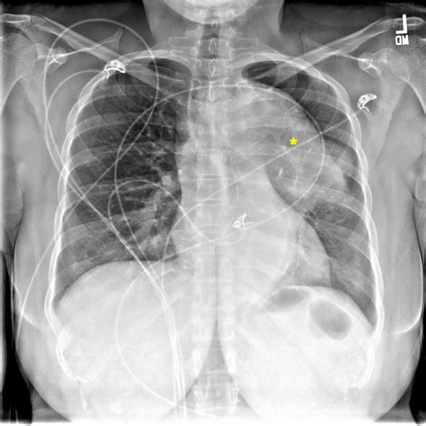 Thoracic Aortic Aneurysm Presenting As A Subacute Cough Pocus Journal