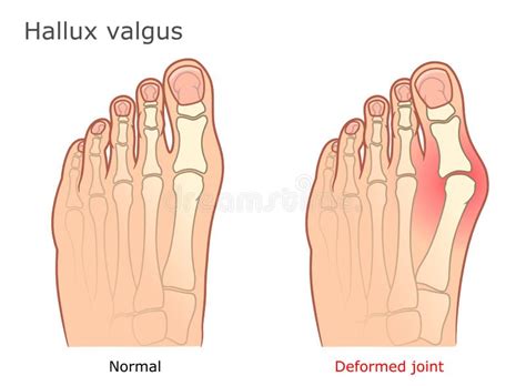 Tarjeta De La Medicina Del Vector Del Valgus De Hallux Ilustración del