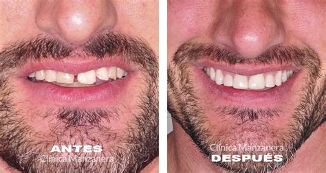 Before And After Composite Veneers Case Cl Nica Manzanera