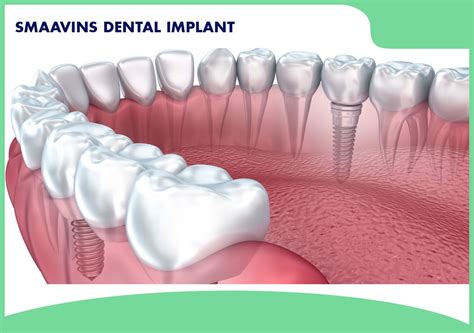 Best Dental Implant In Chennai Dental Treatment Smaavins