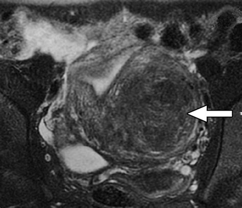 Mr Hysterosalpingography With An Angiographic Time Resolved 3d Pulse