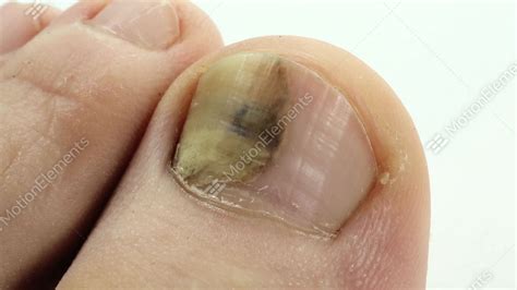 Toenails With Fungal Infection. Sick Nail. Fungus Of Big Toe Stock ...