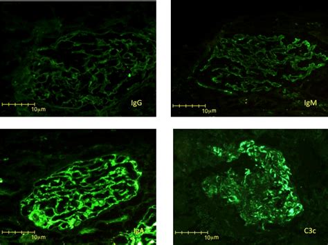 Direct Immunofluorescence Study With Four Immunoreactants Igg And Igm