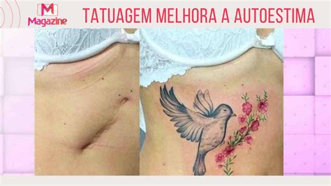 Aprender Sobre Imagem Tatuagem Em Cima De Queloide Br