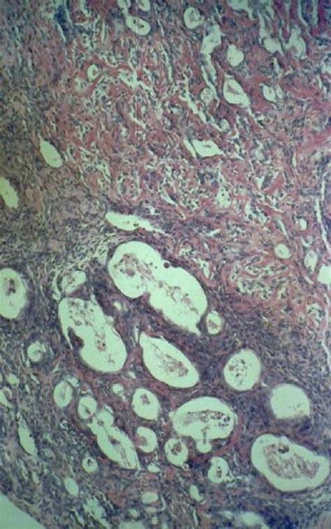 Synovial Sarcoma - Pathology - Orthobullets