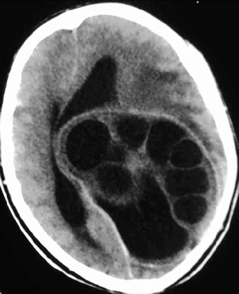 Contrast Enhanced Transverse Ct Image Of Brain Showing A Large Oval