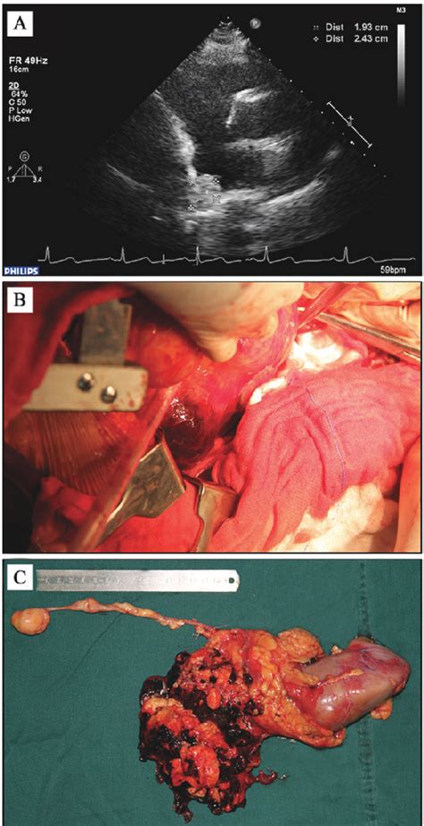 Figure From A Case Of Renal Angiomyolipoma With Intracardiac