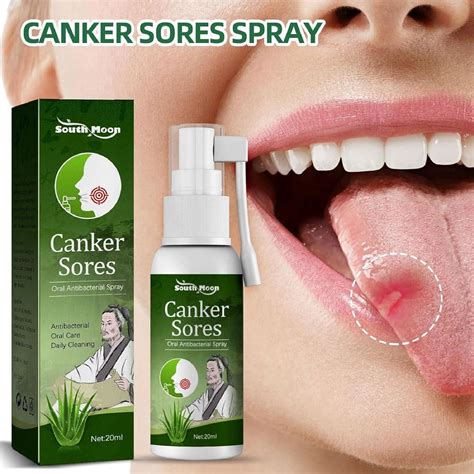 mouth ulcer home remedy 3