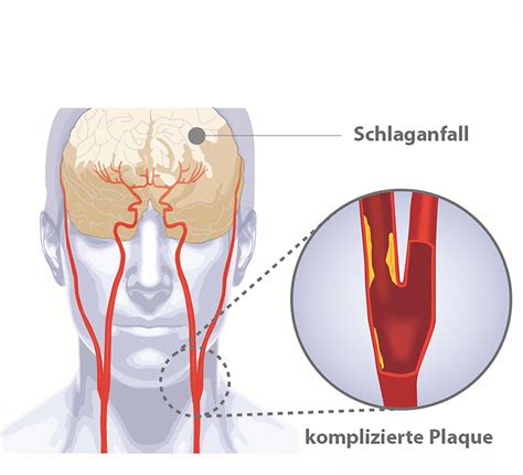 LMU Klinikum Plaques In Den Halsschlagadern Eine Zu Wenig Beachtete