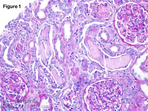 Case 9: A Curious Case of Kidney Casts - Arkana Laboratories