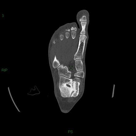 Talocalcaneal Coalition Radiology Case Radiopaedia Org