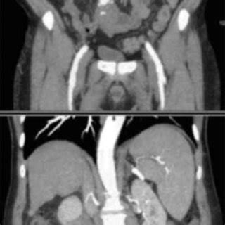 Computed Tomography Angiography Of The Abdomen And Pelvis June 2014