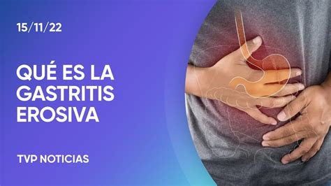 Síntomas De La Gastritis Erosiva Con Sangrado Youtube