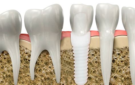 Implantes De Zirconio En Barcelona