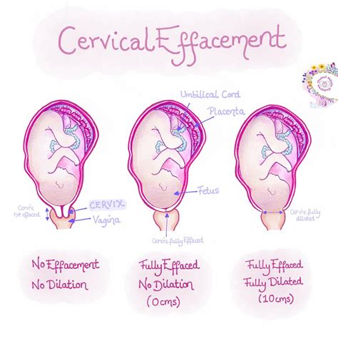 Cervix Dilation Chart Signs Stages And Procedure To Check 52 Off