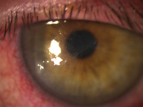 Herpes Simplex Keratitis Managing The Masquerader