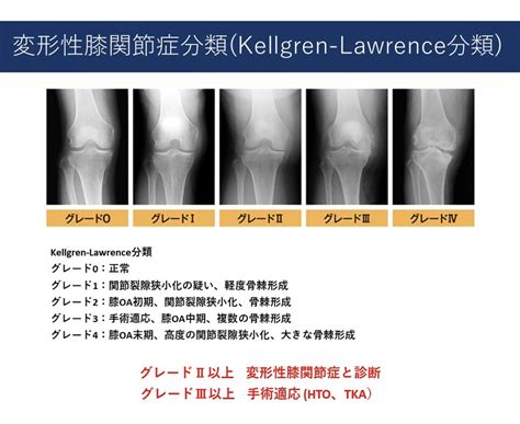 【変形性膝関節症分類】｜d Y Pt