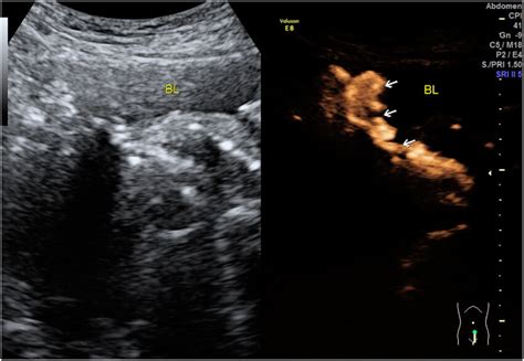 Trans Intrauterine Contrast Enhanced Ultrasound Ceus Sonovue In The