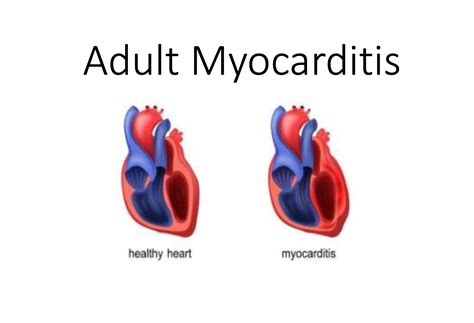 Myocarditis Azzie Salley