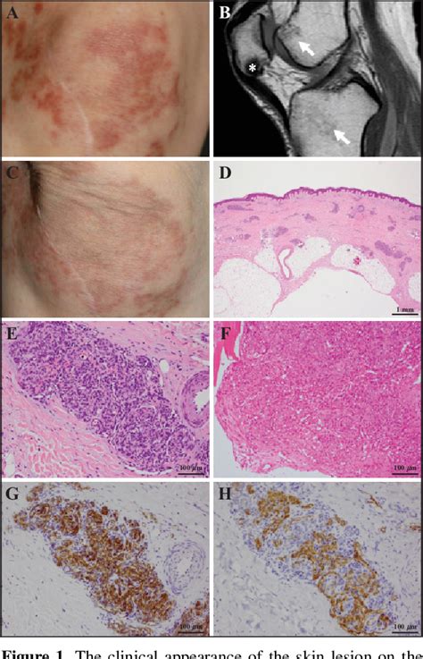 Figure From An Intermediate Vascular Tumour Between Kaposiform