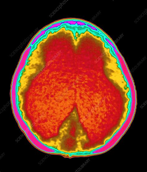 Hydrocephalus CT scan - Stock Image - M170/0248 - Science Photo Library