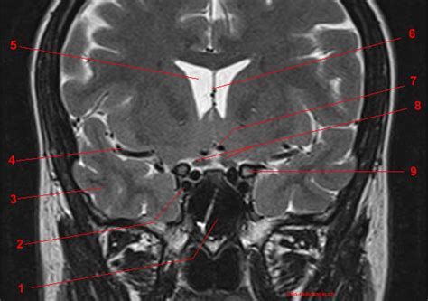 Magnetic Resonance Imaging MRI Of The Turcic Sella Pituitary Gland