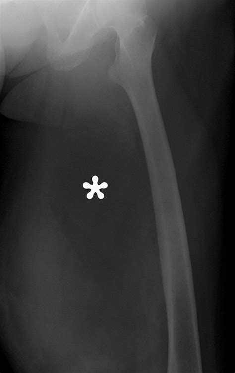 Imaging Of Musculoskeletal Liposarcoma With Radiologic Pathologic