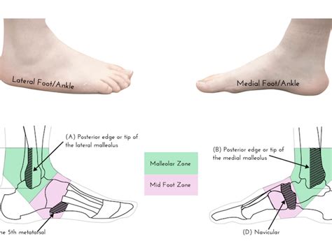 How To Tell The Difference Between A Sprain Or Broken Ankle Nbkomputer