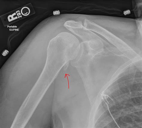 Shoulder Injury And Appropriate Views Radiology Article Radshare Net