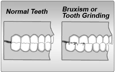 Tinnitus Treatment Center Stop Ringing In Your Ear Forever: Bruxism ...