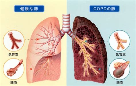 Copd（慢性閉塞性肺疾患）｜山野上内科クリニック