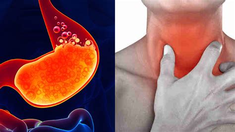 Acidez Esa Sensación De Quemazón En El Estómago Que Afecta A 1 De Cada