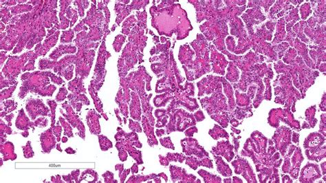 Renal Papillary Necrosis Histology