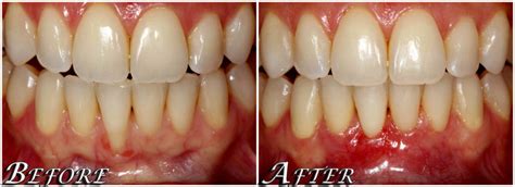 Receding Gums Also Known As Gum Grafting By The Center Smiles