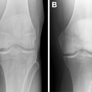 A Preoperative Radiograph Of The Left Knee Showing A Koshino Stage 3