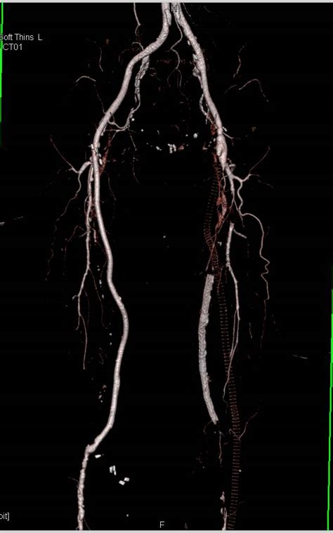 Needcta Runoff With Dual Energy And Single Energy With Occluded Right