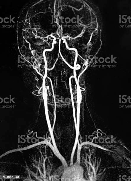 Neck Artery Mra Stock Photo - Download Image Now - Carotid Artery, Illness, Anatomy - iStock