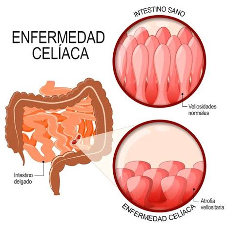 Enfermedad Celiaca Vitamex