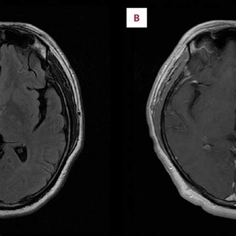 Unilateral Hydrocephalus Due To Congenital Stenosis Of Foramen Of Download Scientific Diagram