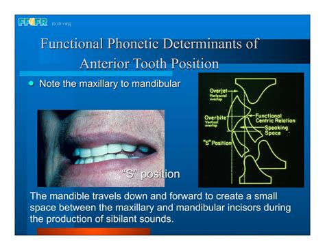 Complete Dentures 16occlusal Schemes Lingualized Occlusion Ppt