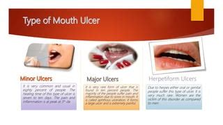 Mouth Ulcer and Cure | PPT