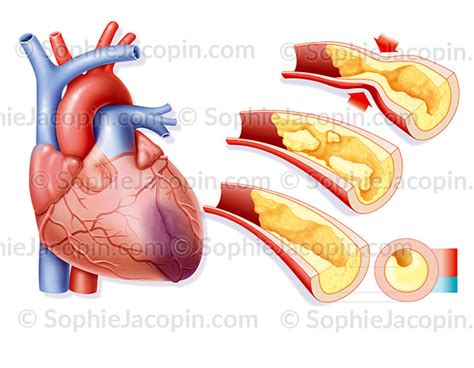 INFARCTUS DU MYOCARDE Illustration Medicale Sophie Jacopin