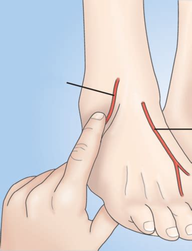 Chapter Peripheral Vascular Disease Flashcards Quizlet