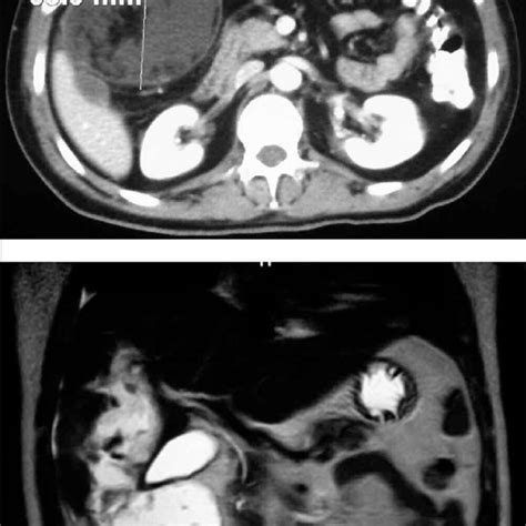 Ct Scan And Nmr Well Delimited Focal Lesion Of X X Cm