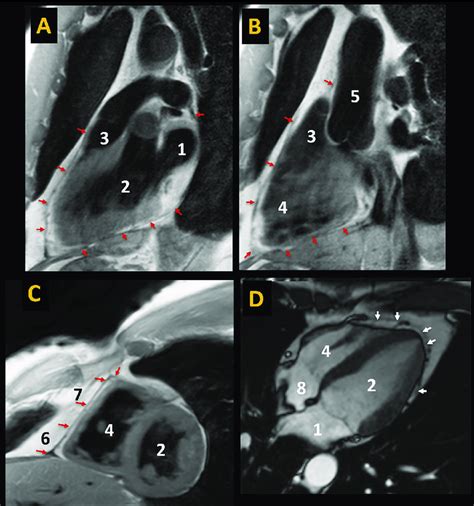 A D Dark T1 Weighted Turbo Spin Echo Blood Sagittal A B And Short