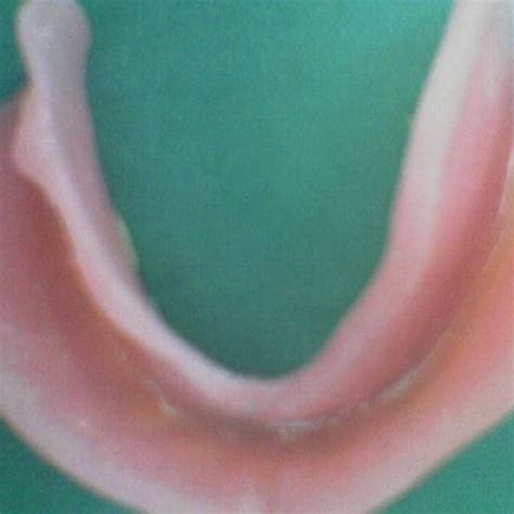 stafne bone cavity enhancemet  complete denture retention