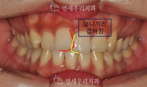 교정전문의 진료일지 앞니교정 전후사진 앞니부분교정 전후비교 잠실치과 연세우리치과