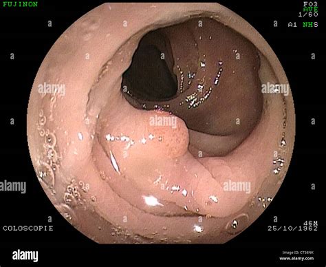 Los pólipos en el colon endoscopia Fotografía de stock Alamy