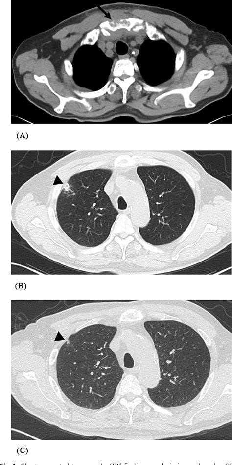 Figure 1 From A Case Report Of Primary Sternal Osteomyelitis Caused By