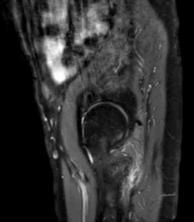 Nondisplaced Incomplete Intertrochanteric Fracture Image